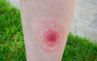 What You Need to Know About Lyme Disease, And How To Prevent It