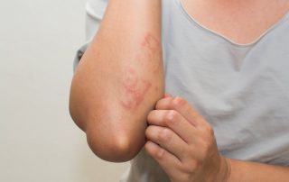 Psoriasis 101: 5 Ways to Help Prevent Psoriasis Flare-Ups
